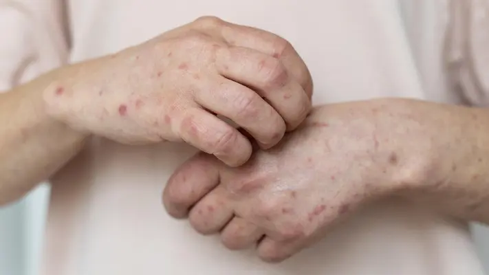¿Aumentan casos de sarampión? Llaman a la población a vacunarse