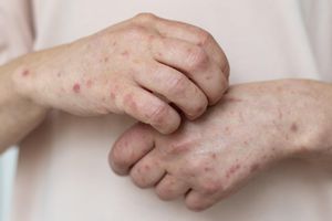 ¿Aumentan casos de sarampión? Llaman a la población a vacunarse