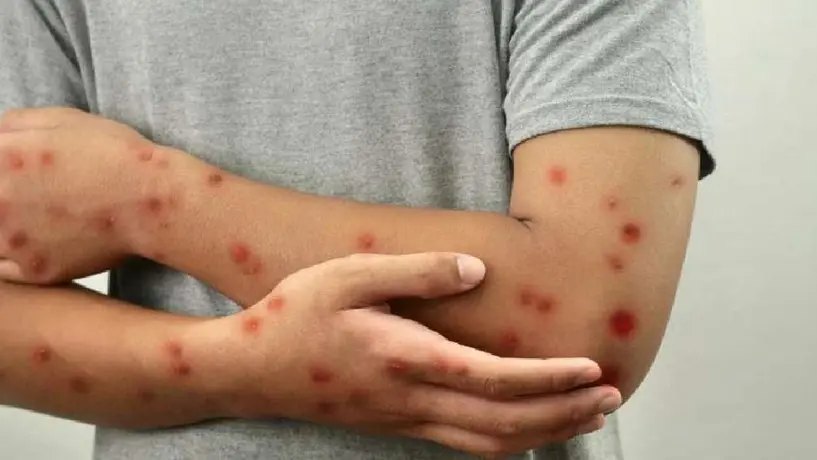 UNAM emite medidas de prevención ante aumento de casos de sarampión en CDMX