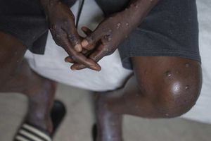 ¿Cómo evitar contagiarse de la viruela del mono?