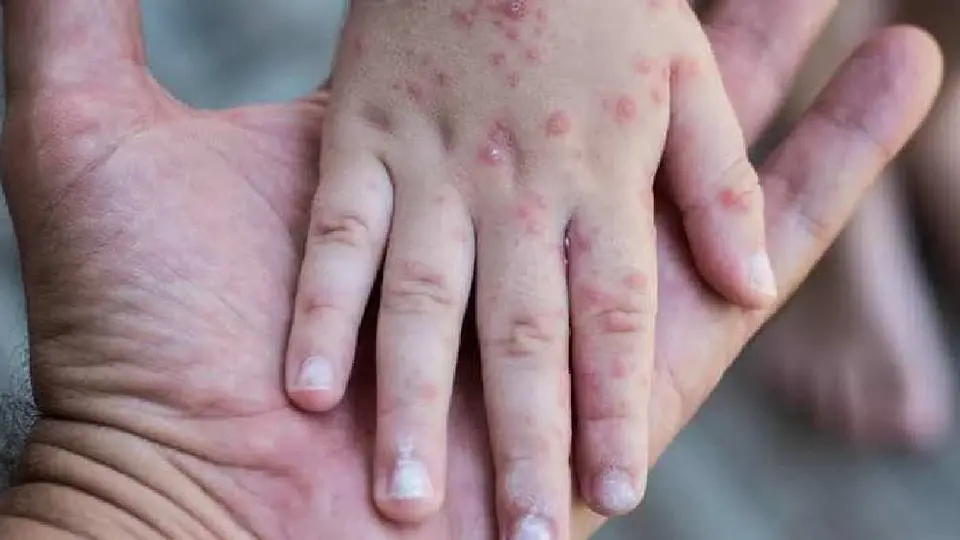 Emiten alerta sanitaria por el virus coxsackie en Hidalgo