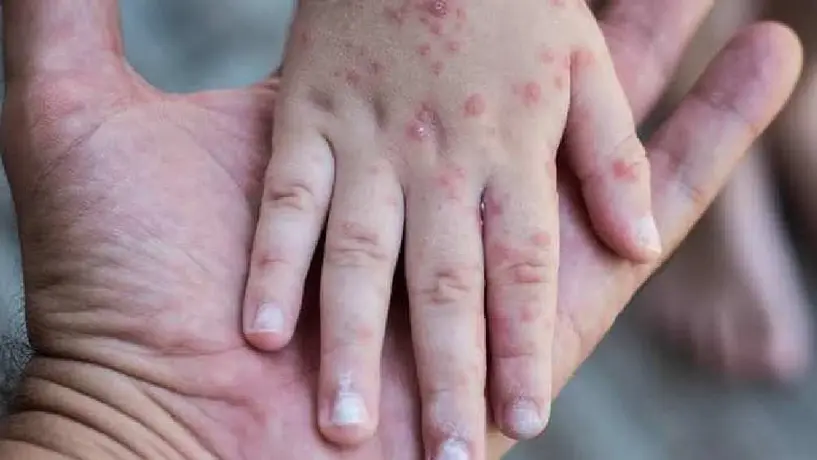 Emiten alerta sanitaria por el virus coxsackie en Hidalgo