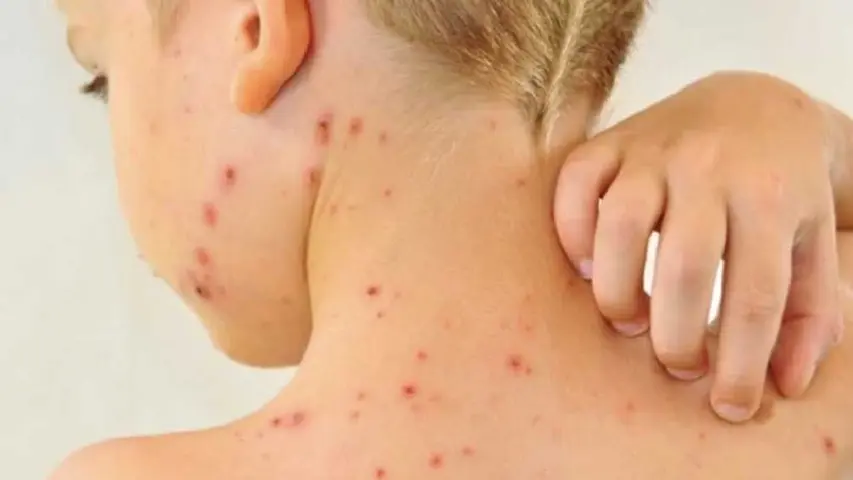 La Secretaría de Salud alertó sobre casos activos de sarampión en el país. / Pixabay