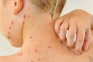 ¡Alerta! Secretaría de Salud informa que hay 7 casos activos de sarampión en el país