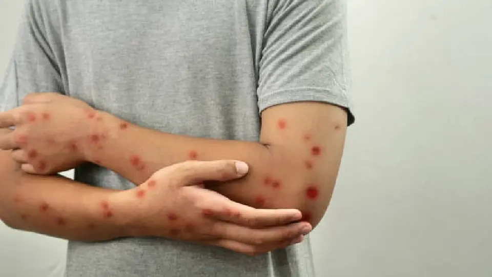 Tailandia confirma el primer caso de Viruela del Mono o mpox