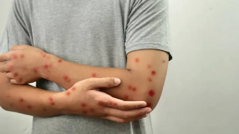Tailandia confirma el primer caso de Viruela del Mono o mpox