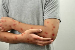 Tailandia confirma el primer caso de Viruela del Mono o mpox