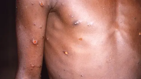 Viruela del Mono: En Brasil matan a monos por temor al virus