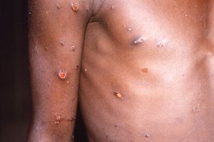 Viruela del Mono: En Brasil matan a monos por temor al virus