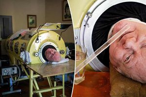 Murió Paul Alexander, el hombre que durante 70 años vivió dentro de un pulmón de acero