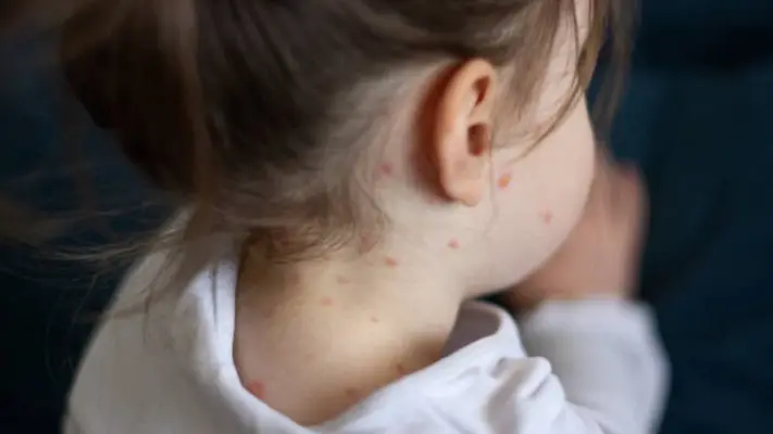 Campaña contra el sarampión, arranca en la Ciudad de México ¡Vacuna a los niños!