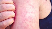 ¡Alerta! la OMS se preocupa por el aumento de sarampión en el mundo