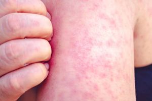 ¡Alerta! la OMS se preocupa por el aumento de sarampión en el mundo