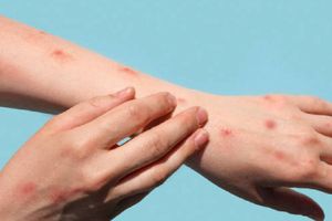 Se ha reportado la primera muerte por viruela en Alaska