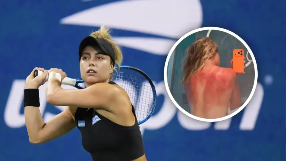 Las marcas del sol en la espalda de Renata Zarazúa durante la gira australiana