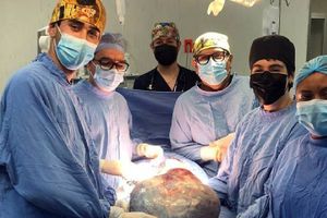 Médicos del IMSS retiran tumor de 21 kilos a señora de 60 años