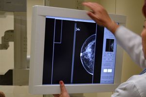 Sudor, nuevo método para detectar cáncer de mama