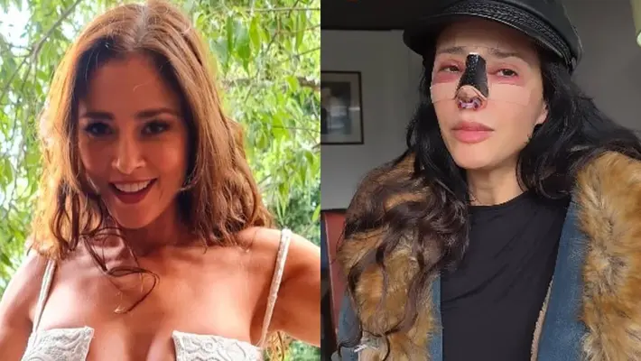 FOTOS: Dorismar reaparece con el rostro desfigurado tras mala cirugía estética
