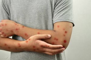 Sarampión en México: Reportan aumento de casos en diciembre ¿Cuáles son los síntomas?