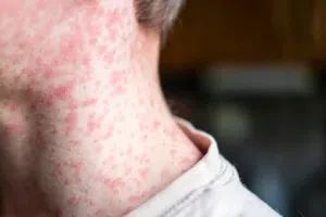 CDMX alerta por aumento de sarampión: ¿quiénes deben vacunarse ya?