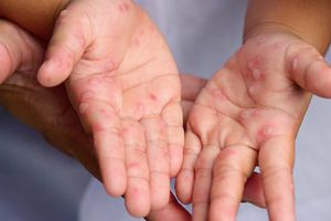 Suspenden festejos de Día de Muertos por brote del virus Coxsackie