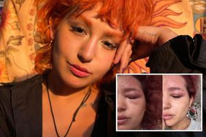 Romina Marcos: ¿qué es el herpes zóster que padece la hija de Niurka?