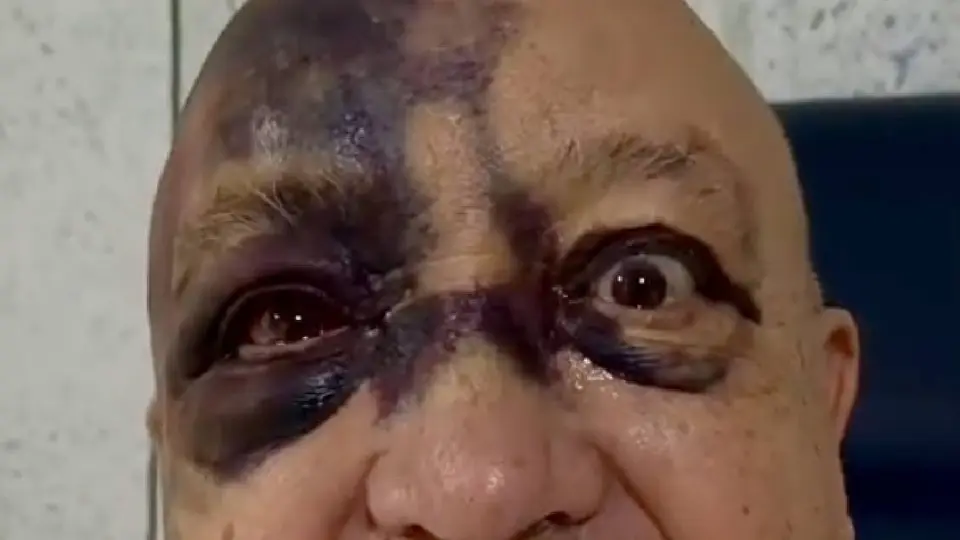 Luis de Alba reaparece con el rostro lleno de moretones; el “Pirrurris” revela qué le pasó