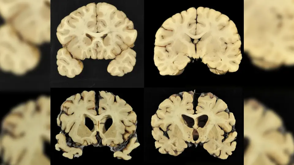 Cerebro afectado por el CTE | AP
