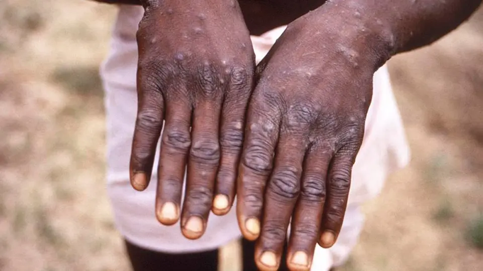 Viruela del Mono: Estados Unidos declaró emergencia sanitaria por brote