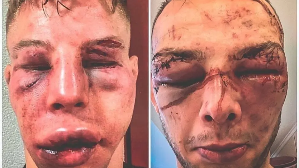 Video: Makarowski y Blezien terminaron desfigurados tras su pelea en MMA