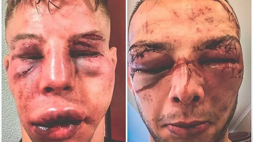 Video: Makarowski y Blezien terminaron desfigurados tras su pelea en MMA