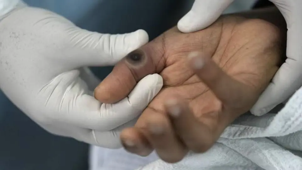 Estados Unidos: Aparece tercer caso de Viruela del mono en un niño