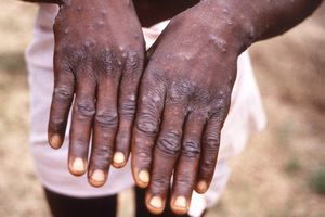 OMS: Declaró la viruela símica como una emergencia global