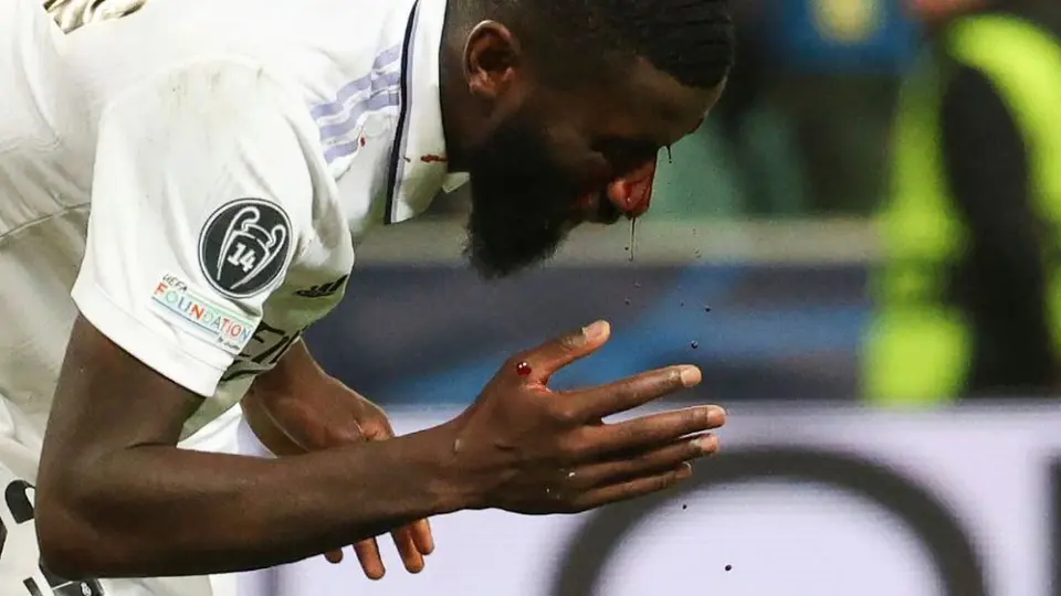 Real Madrid: Así quedó el ojo de Rüdiger tras el golpe que recibió durante el partido vs Shakhtar