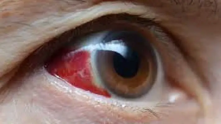 OMS emite alerta sanitaria por virus mortal que provoca sangrado de ojos