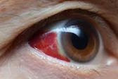 OMS emite alerta sanitaria por virus mortal que provoca sangrado de ojos
