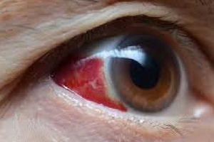 OMS emite alerta sanitaria por virus mortal que provoca sangrado de ojos