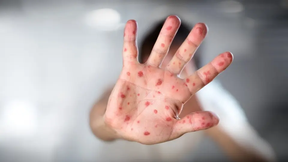 Viruela del mono: 10 razones para no ‘alertarse’ ante la amenaza de este virus