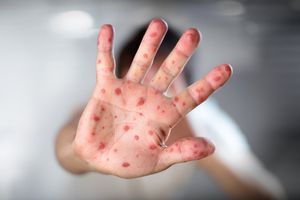 Viruela del mono: 10 razones para no ‘alertarse’ ante la amenaza de este virus