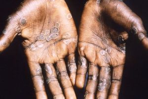 Secretaría de Salud emitió aviso epidemiológico por viruela del mono