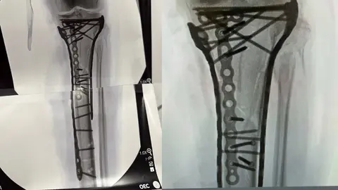 Lindsey Vonn compartió las imágenes de sus radiografías | INSTAGRAM