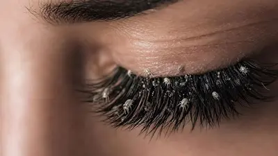 ¿Qué riesgos tienen las extensiones de pestañas? Expertos advierten sobre ácaros