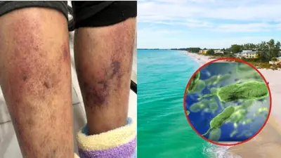 “Bacteria carnívora” deja 12 muertos en EU: ¿qué tan peligrosa es y tiene cura?