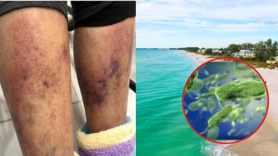 “Bacteria carnívora” deja 12 muertos en EU: ¿qué tan peligrosa es y tiene cura?