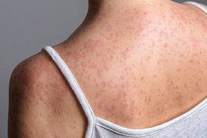 ¿Estás en riesgo por el sarampión? Esto dice la UNAM sobre adultos mayores y vacunación