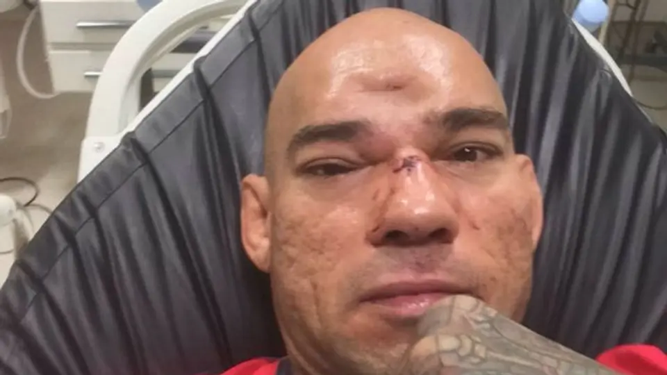 Peleador de MMA sufre dramática fractura en el cráneo