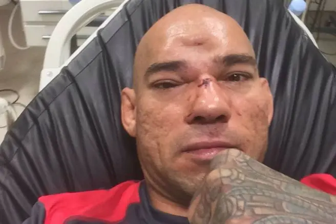 Peleador de MMA sufre dramática fractura en el cráneo