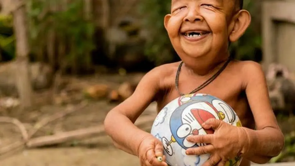 Niño padece enfermedad que lo hace ver como anciano