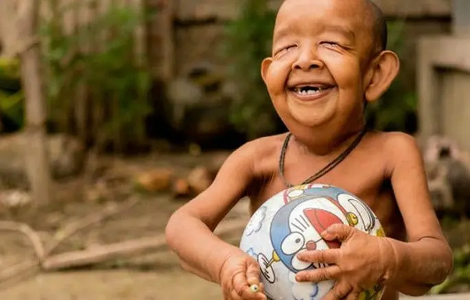 Niño padece enfermedad que lo hace ver como anciano