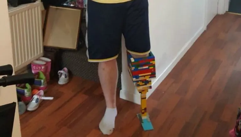 Joven fabrica una 'pierna de Lego' para concientizar sobre la diabetes